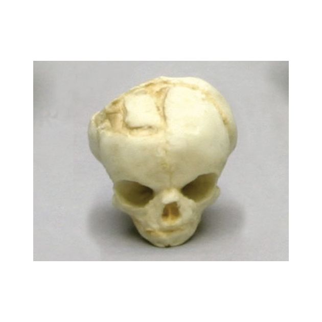 Crâne d&rsquo;un foetus de 17 semaines