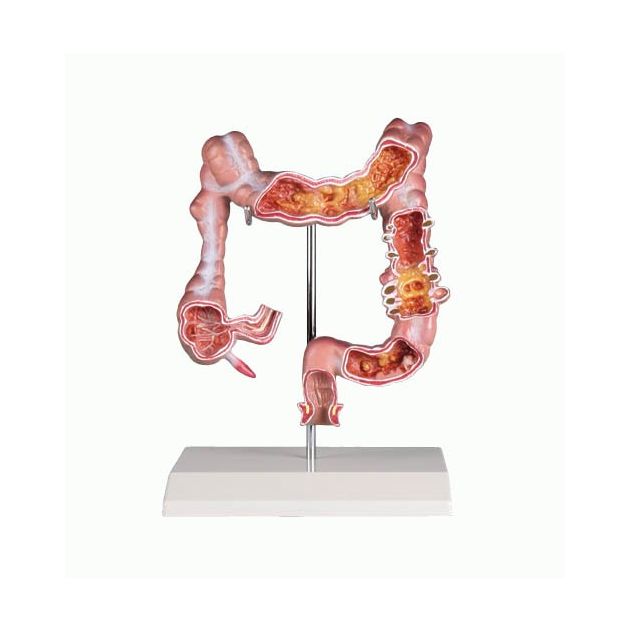 Maladie du colon