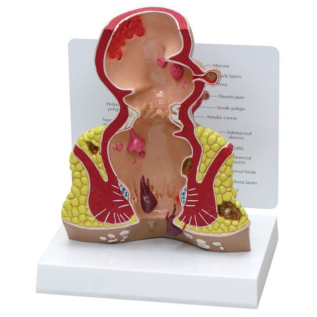 Rectum, agrandissement 1.5x